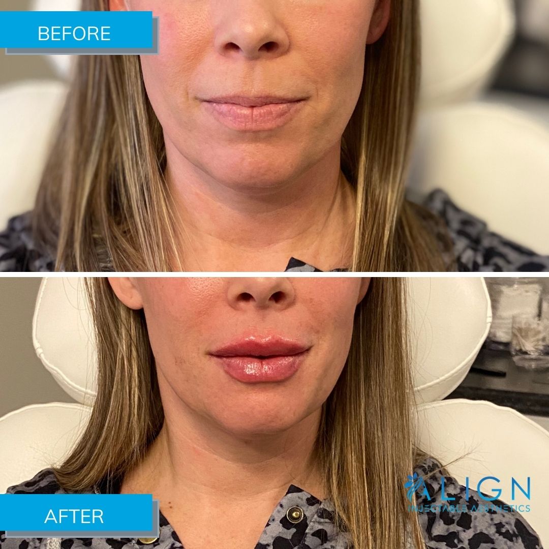 Before and After Lip Injections at Align Injectable Aesthetics