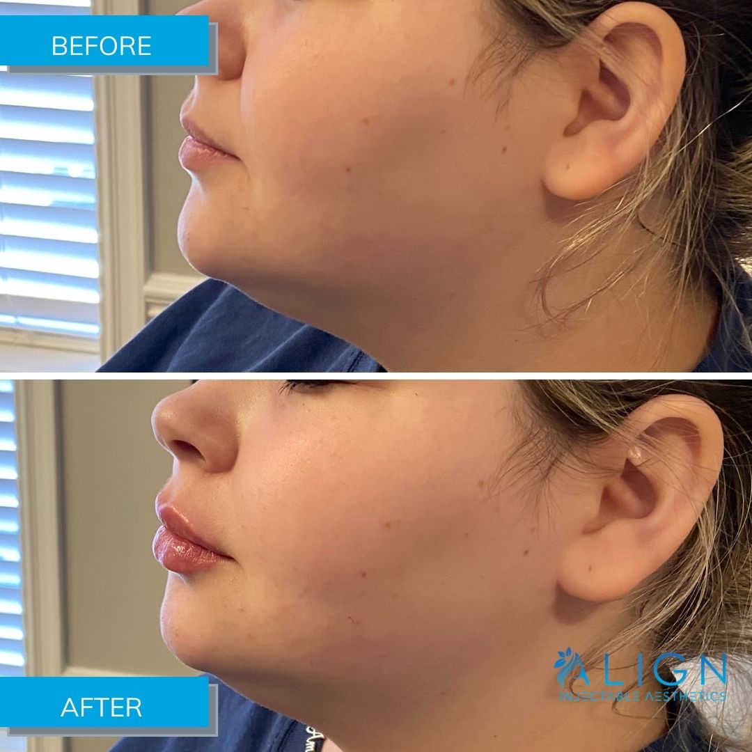 Before and After Lip Injections Align Injectable Aesthetics
