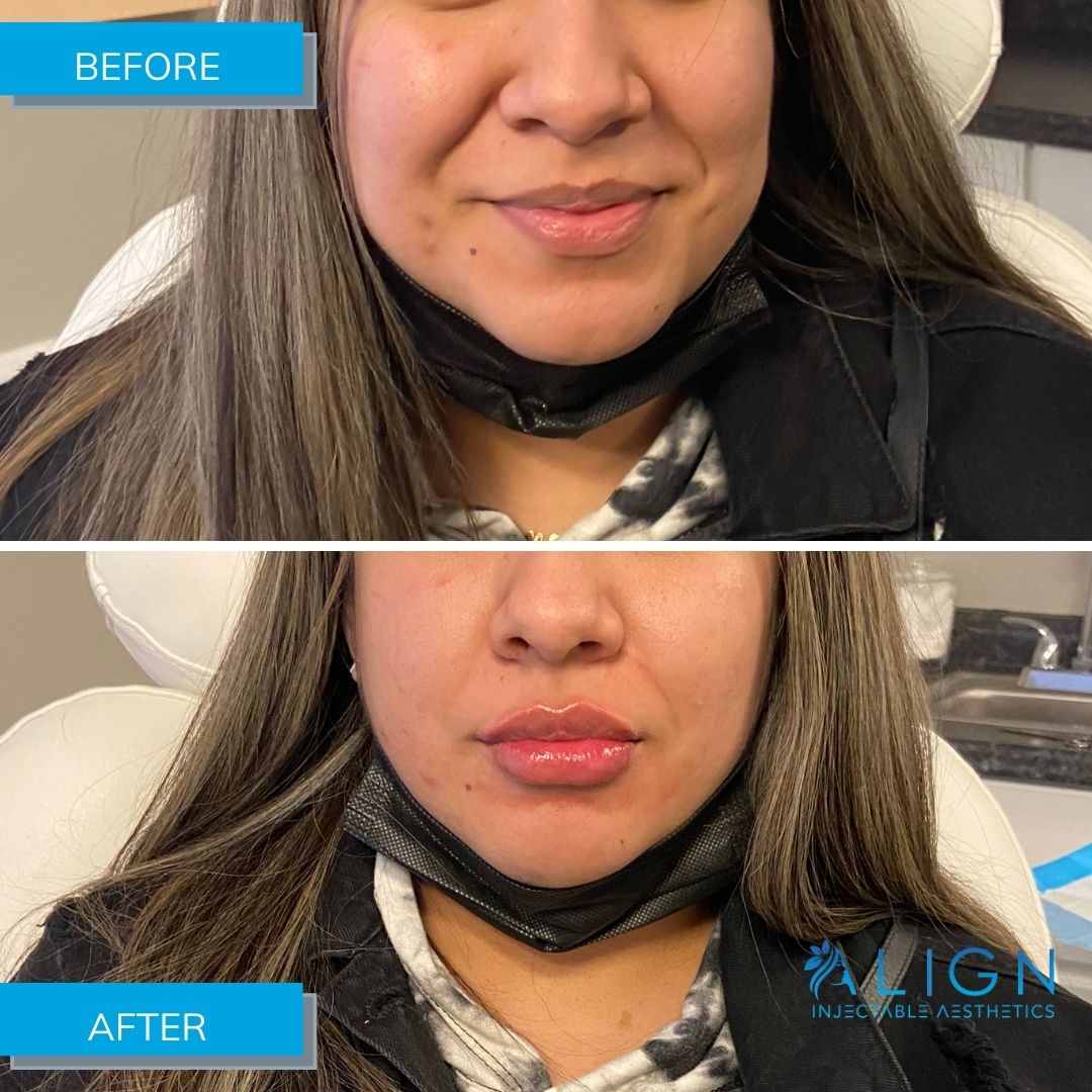 Before & After Results Align Injectable Aesthetics