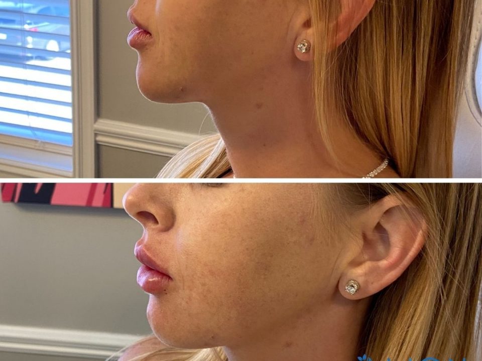 Lip Injections Tulsa, OK Align Injectable Aesthetics