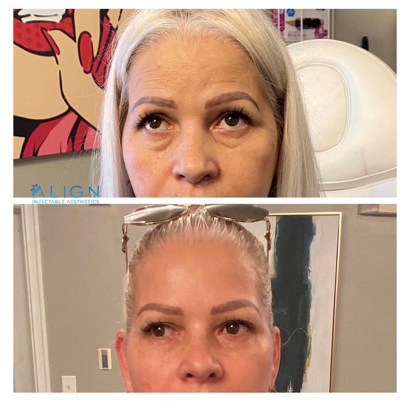 Agnes RF NonSurgical Facial Contouring Align Injectable Aesthetics