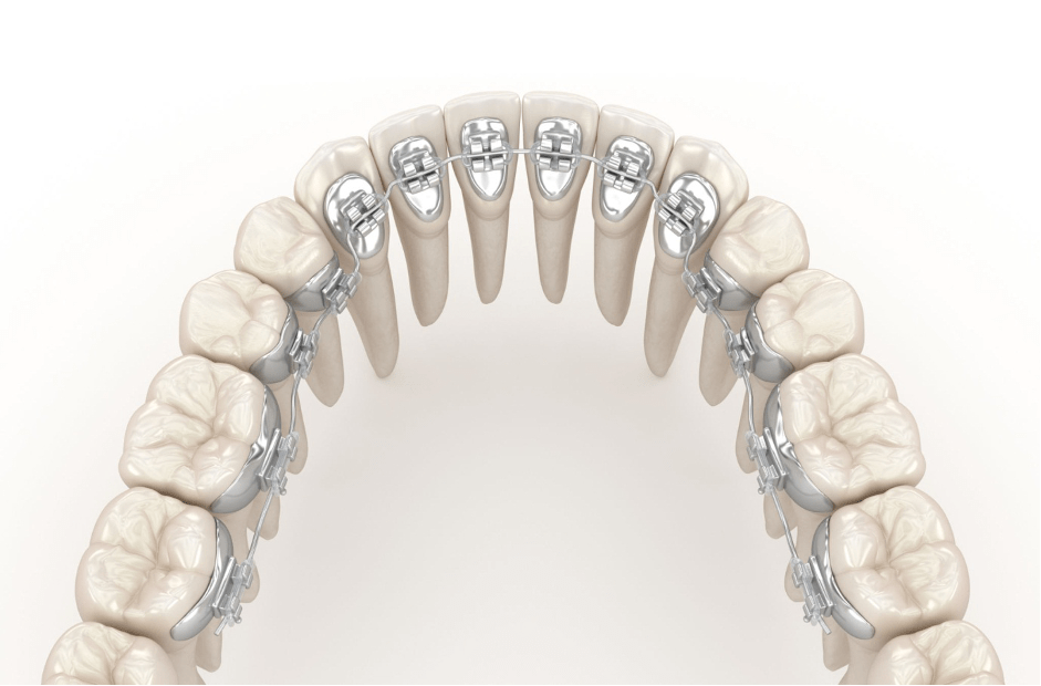 Lingual Braces Incognito Braces Inbrace