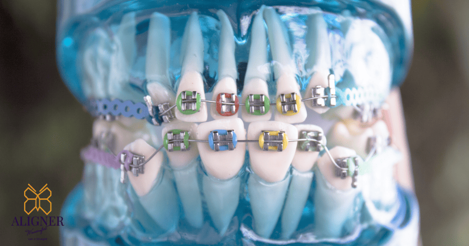 How Much Does Braces Cost in Malaysia Full Guide [2023]