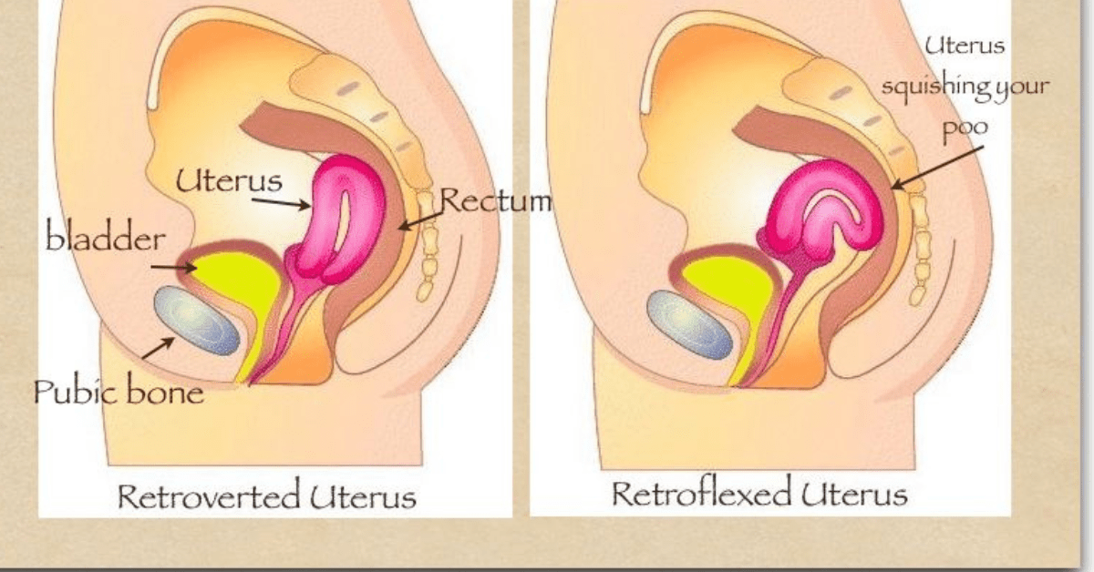 Retroverted (Tilted) Uterus: Causes, Symptoms Fertility, 44% OFF