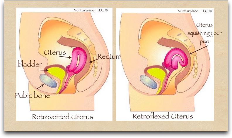 Retroverted Uterus A Natural Solution - Alignment Monkey