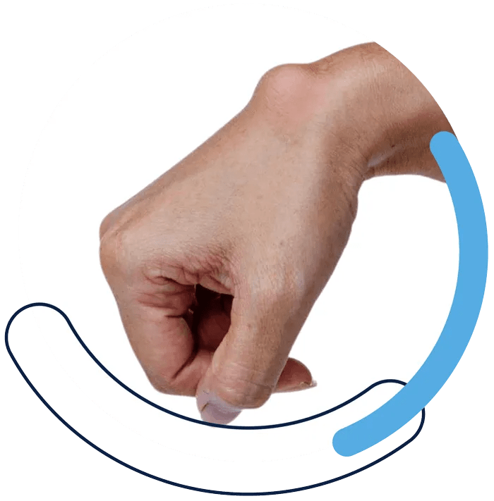 Ganglion Cyst Treatment in Hampshire Expert Care Available