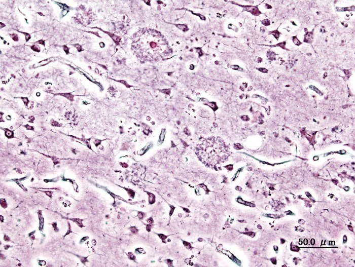 New Alzheimer's Drug Wildly Successful In Trials
