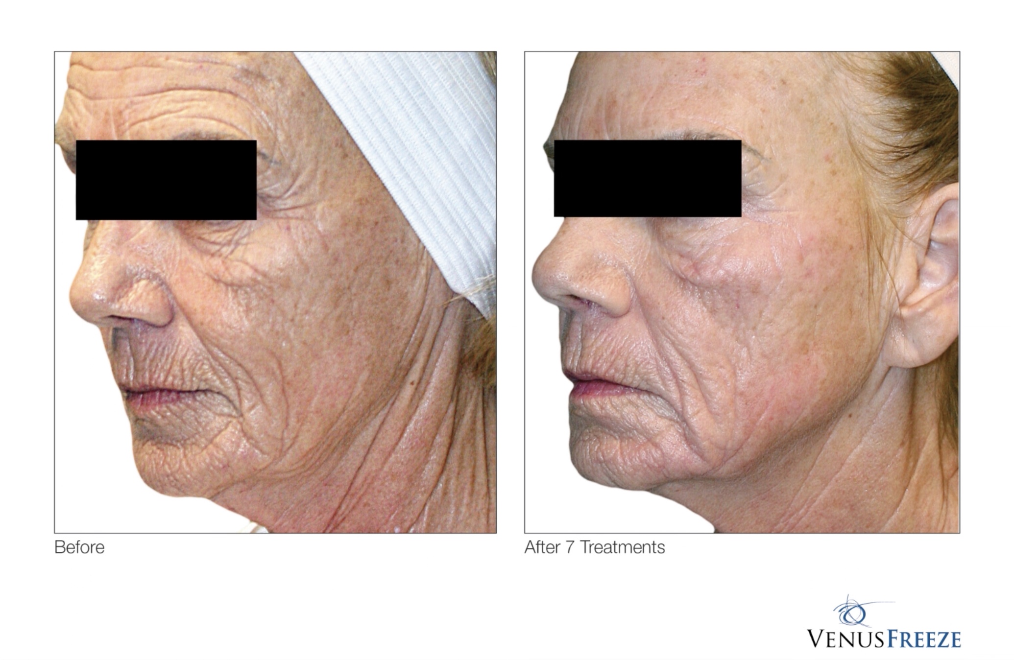 Venus Freeze All About Me Laser Med Spa