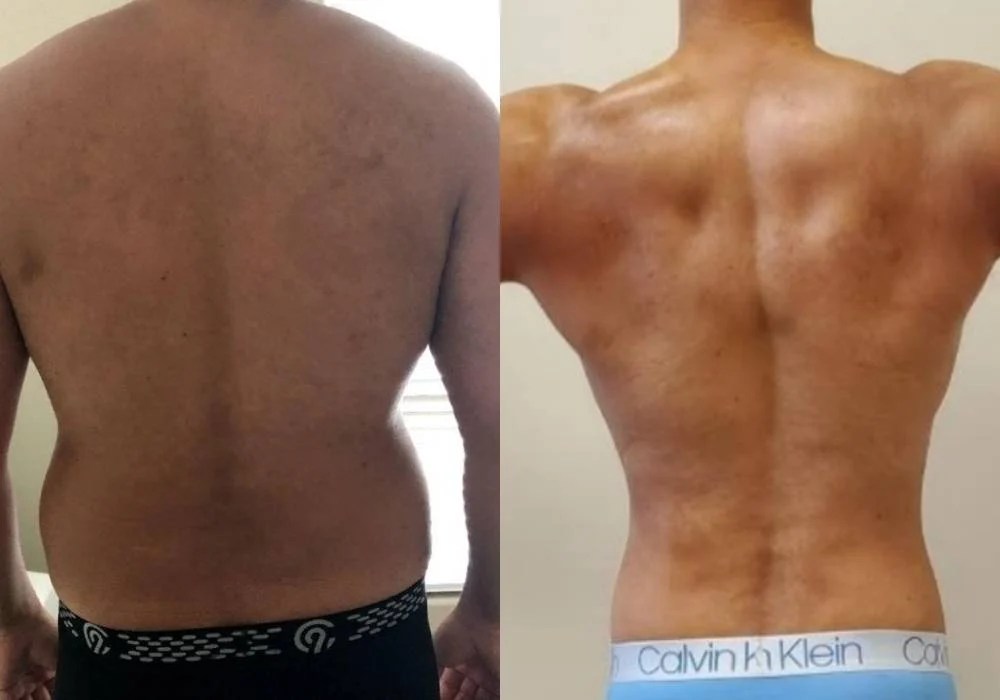 Laser Lipo Treatment For in Orange County