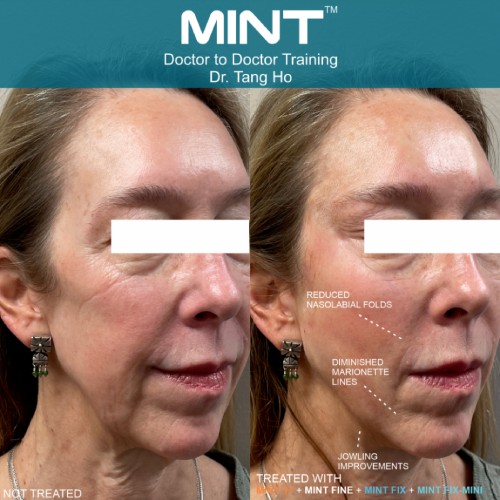 PDO Thread Lift Best Treatment To Reduce Jowls in Orange County