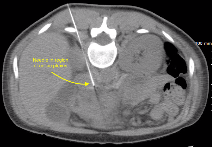 Celiac Plexus Block Atabak Allaei, MD Vascular & Image Guided Specialist Los Angeles CA