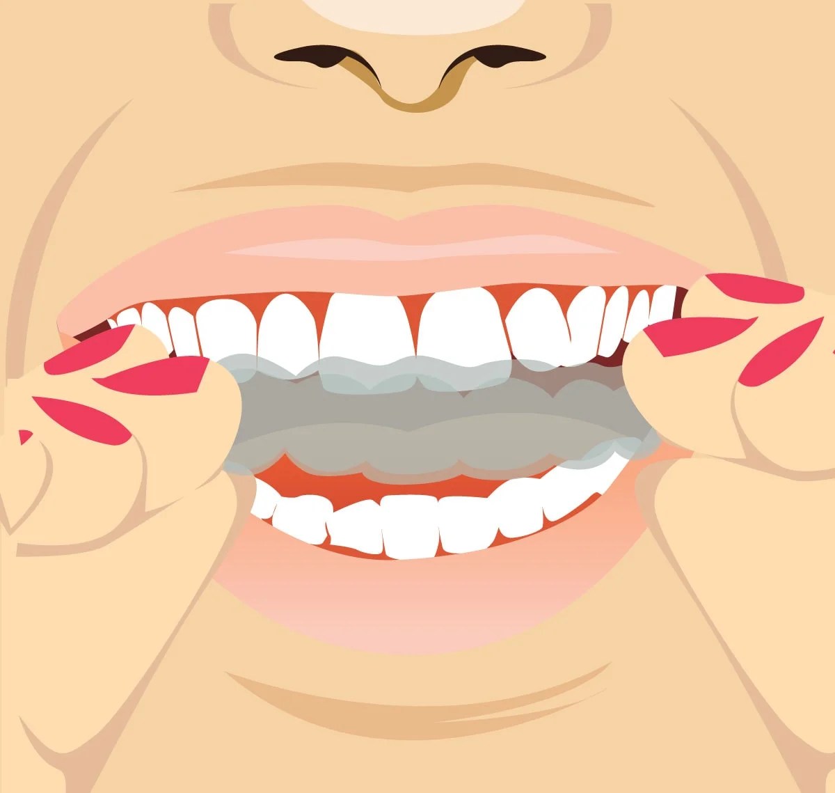 SW Edmonton Dentist Teeth Whitening Instructions Allard Station Dental