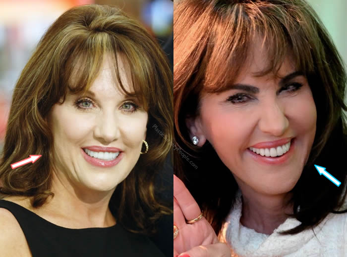 Has Robin Mcgraw Had Cosmetic Procedures? Celebrity