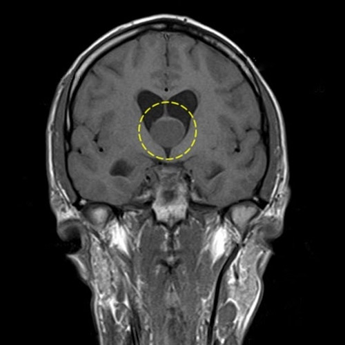 Arachnoid cysts of the brain All information about cysts