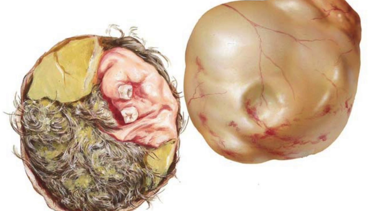 Dermoid cyst everything to know. What's its main danger?