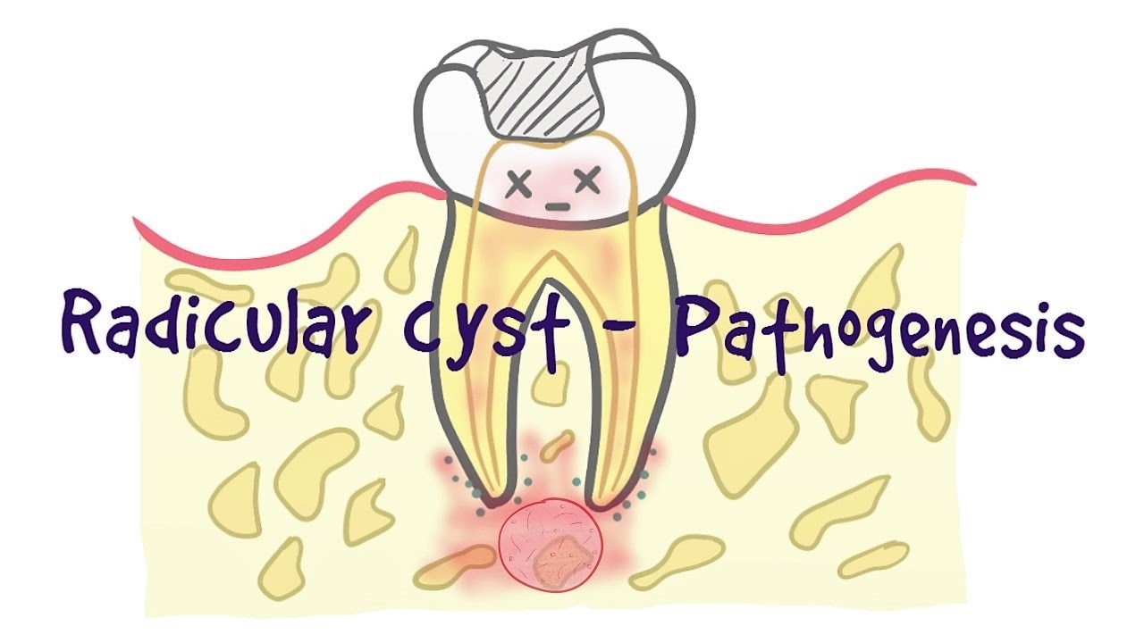 Full list of 6 dental cyst types. What is a cyst on a tooth? How