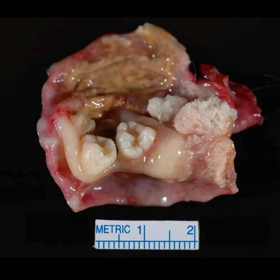 Dermoid cyst diagnosis and symptoms. 5 ways to find out