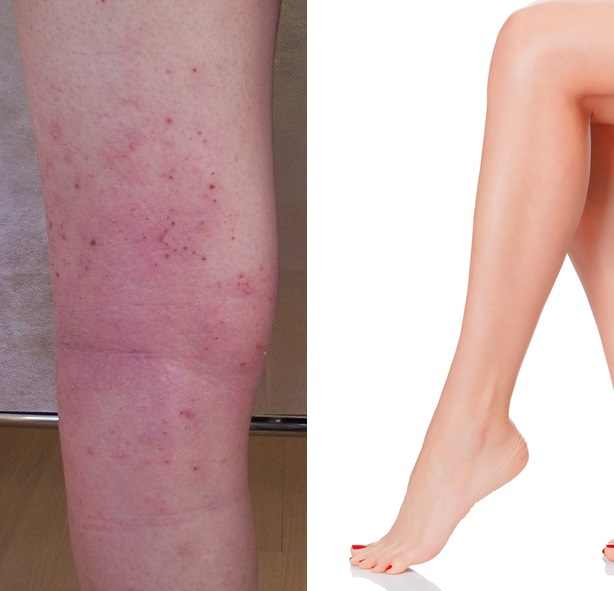 How to Avoid and Get Rid of Shaving Bumps AllDayChic