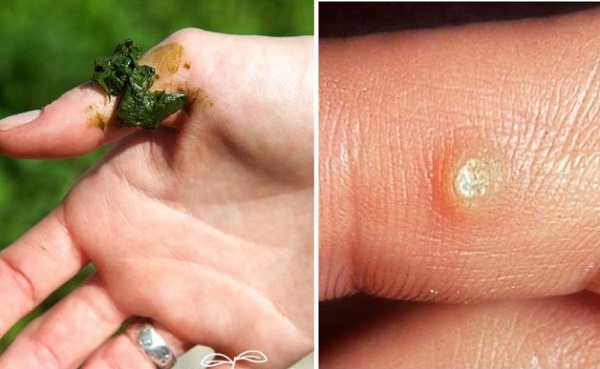 How To Get Rid Of Warts With Home Remedies AllDayChic