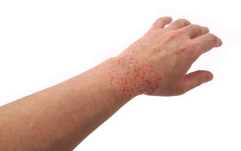 Beyond Bread and Beer Understanding Yeast Allergy and Managing its