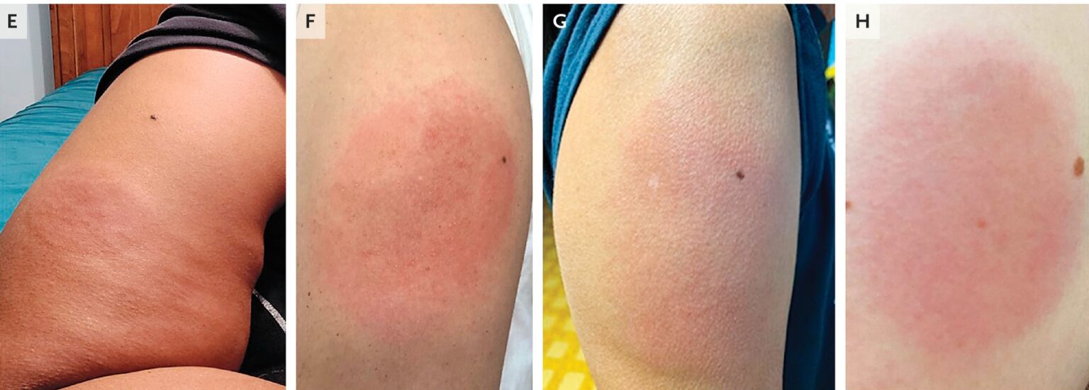 Publications Mass General Allergy Research