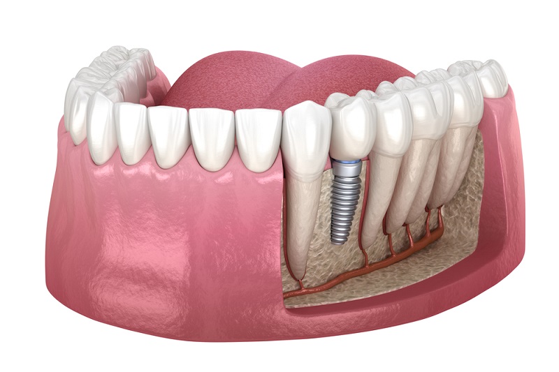Is Denture Implant Worth? Know here! AllexpertBlog