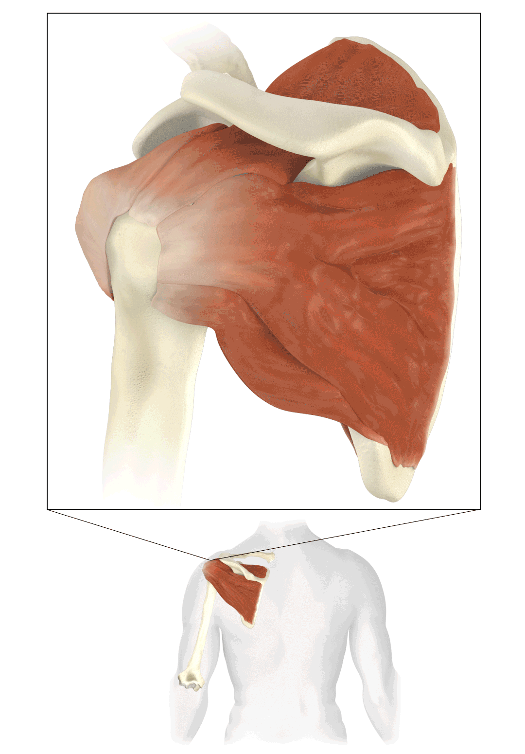 Torn_Rotator_Cuff Allison Sugden