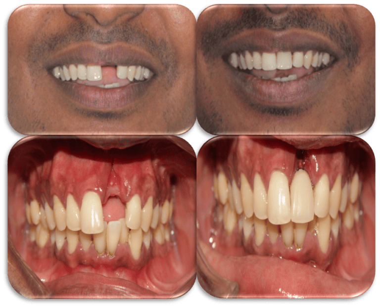Before/ after treatment photos