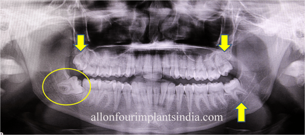 Cost of wisdom tooth removal in Chennai, India