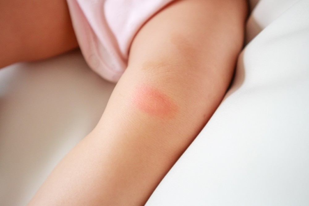 Tips To Keep Kids Safe from Bedbugs's Bite All Pest Control Newcastle