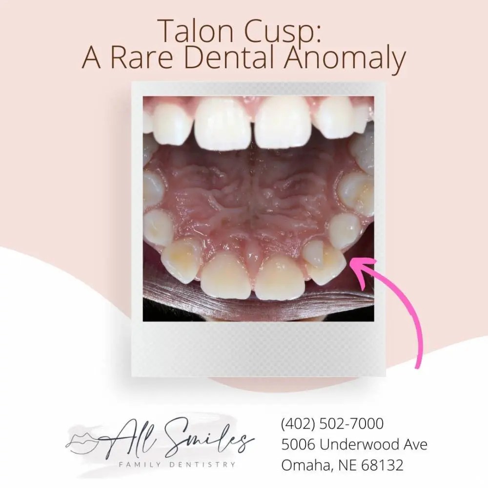 How Rare Is A Talon Cusp Tooth? All Smiles Family Dentistry