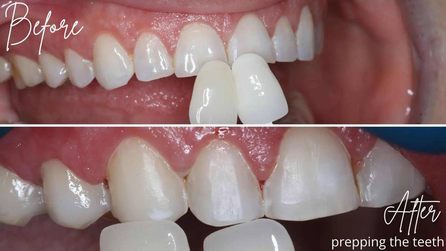 Do You Have to Shave My Teeth Down to Do Veneers? All Smiles