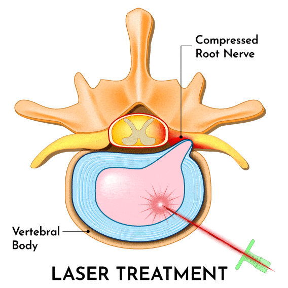 Herniated disc laser AllSpine
