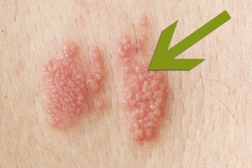 Gürtelrose Ist sie ansteckend? Symptome & Behandlung