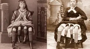 Myrtle Corbin four legged woman