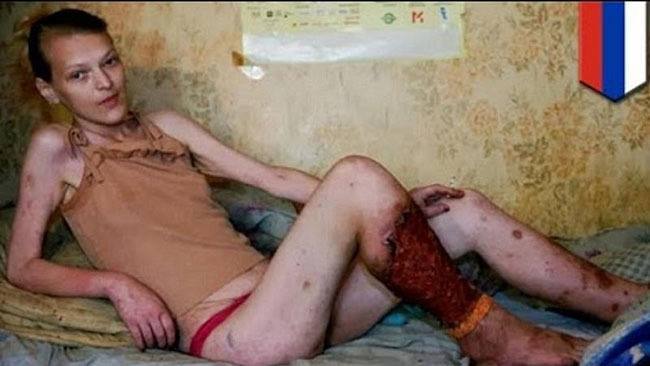 Krokodil Flayed Leg