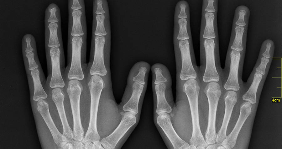 X Ray Hands