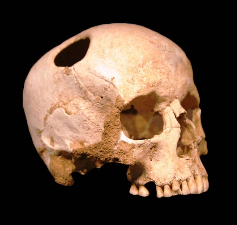 Trepanation On A Skull