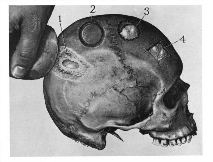 Trepanning Methods