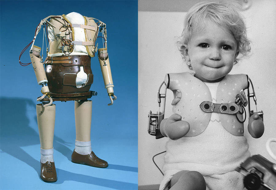Thalidomide Children With Prosthetics