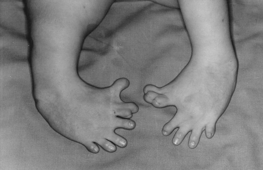 Thalidomide Babies