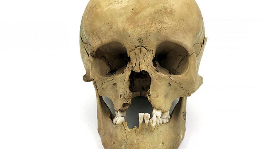Skull With Cleft Palate