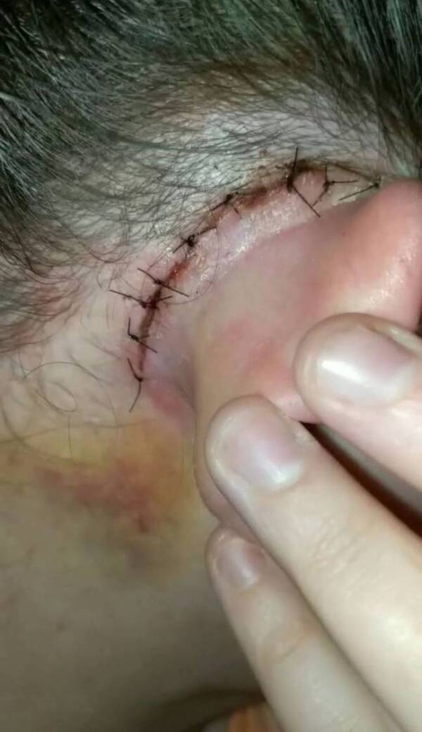 Gemma Cairns Post Ear Surgery