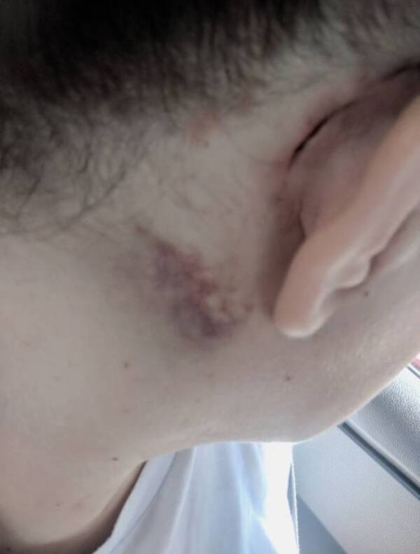 Healed Ear Of Gemma Cairns