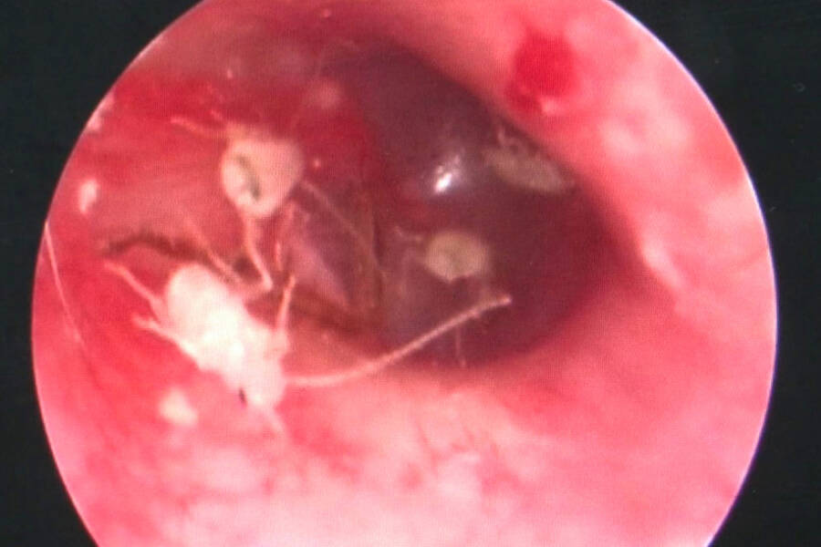 Cockroach Mother Inside Man&rsquo;s Ear