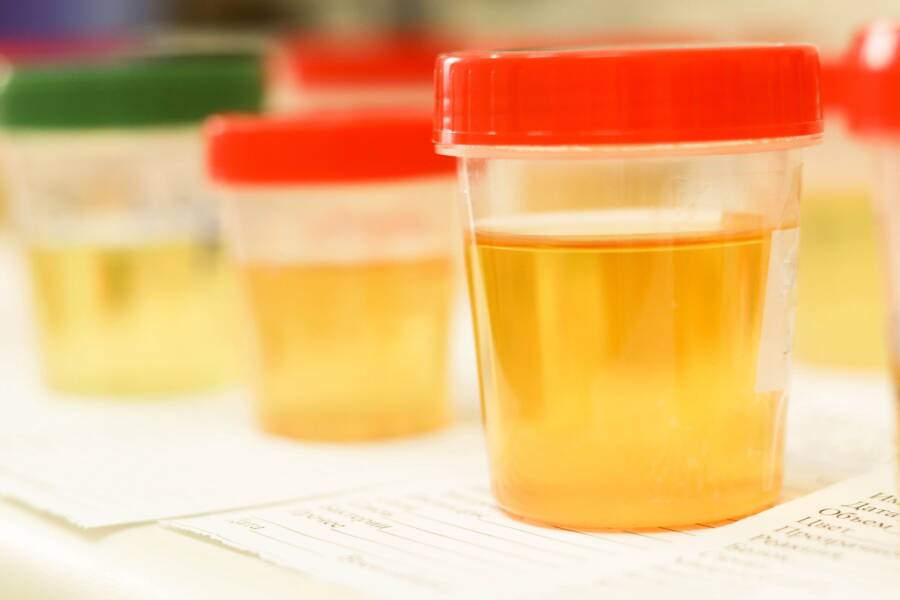 Urine Samples