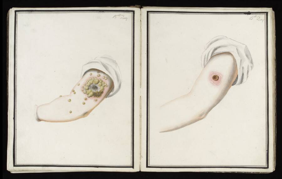 Smallpox Inoculation