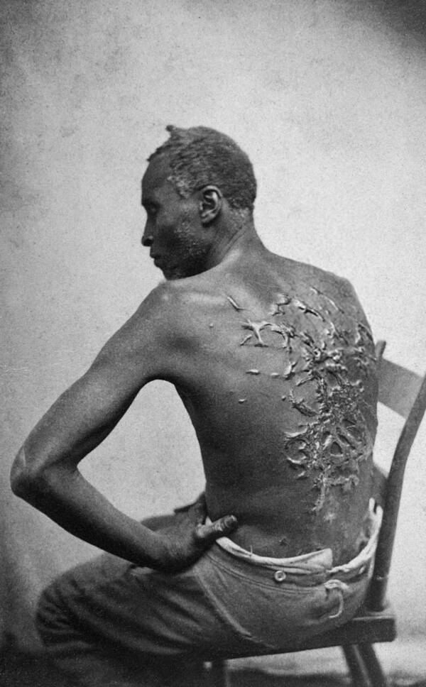 Scars On Enslaved Man’s Back