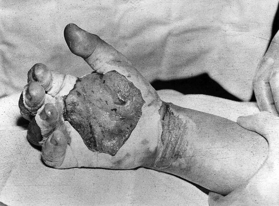 Harry Daghlian Hand