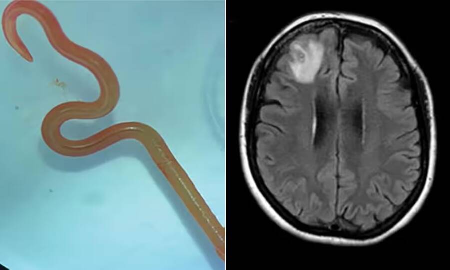 Roundworm In Woman’s Brain